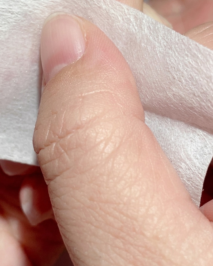Ein mit Reinigungsflüssigkeit getränktes Nail-Wipe reinigt die Nageloberfläche.
